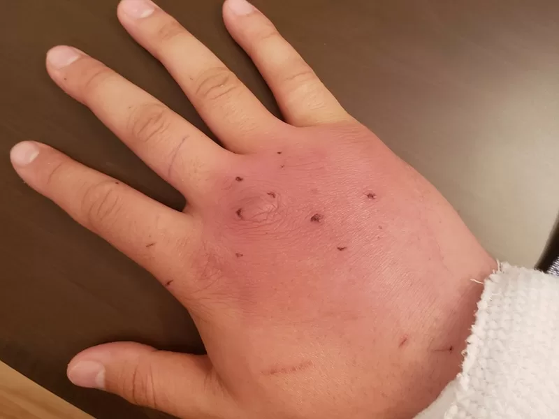 swollen hand bite